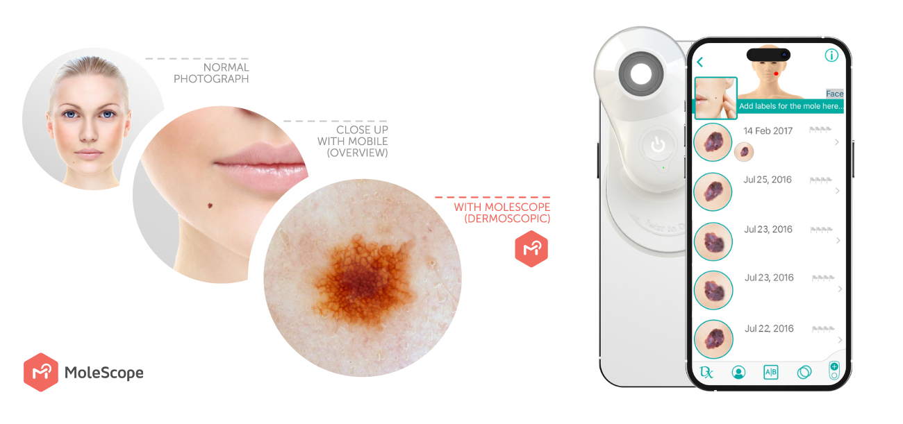 Dermatoscopy | An Evolving Process Benefiting All