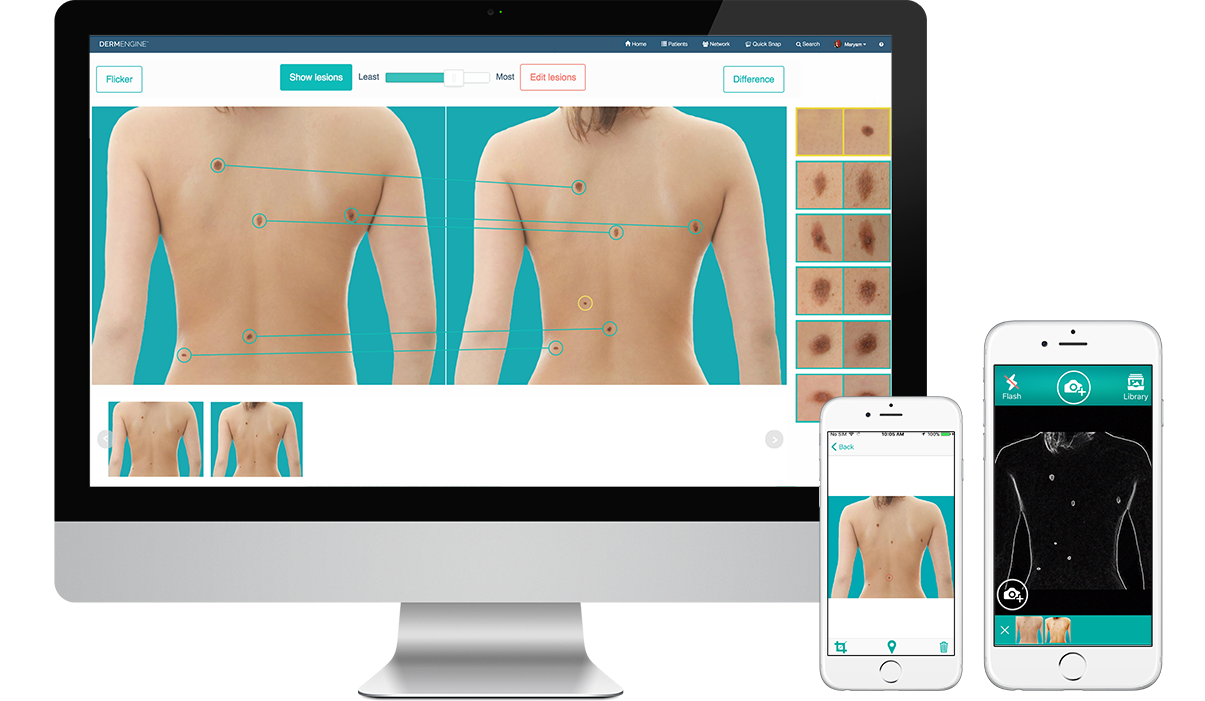 Total Body Photography (whole body screening) captures and analyzes full body images for lesion detection and the evaluation of new or changing moles